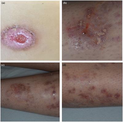 Pyoderma gangrenosum following anti-TNF therapy in chronic recurrent multifocal osteomyelitis: drug reaction or cutaneous manifestation of the disease? A critical review on the topic with an emblematic case report